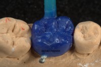 Inline Pom - Laboratorio Protesis Dentales Jacobo Chicher