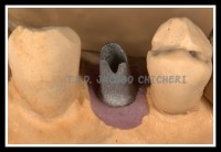 Pilar de Titanio Mecanizado Biomet 3i - Laboratorio Protesis Dentales Jacobo Chicheri