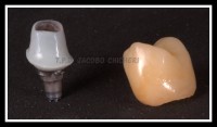 Pilar Ceramizado y Corona Emax - Laboratorio Protesis Dentales Jacobo Chicheri