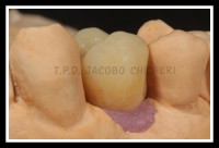 cementacion de la Corona Emax Press - Laboratorio Protesis Dentales Jacobo Chicheri